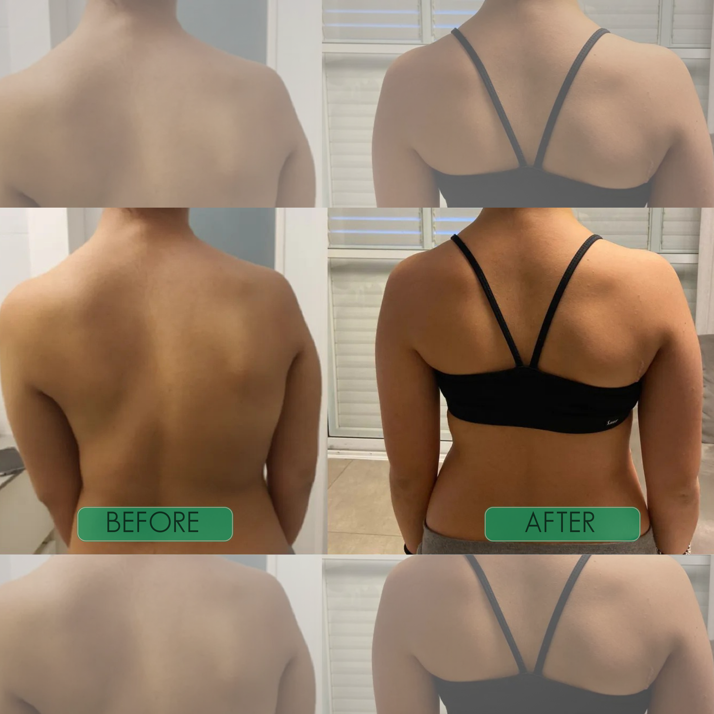 Posture Corrector