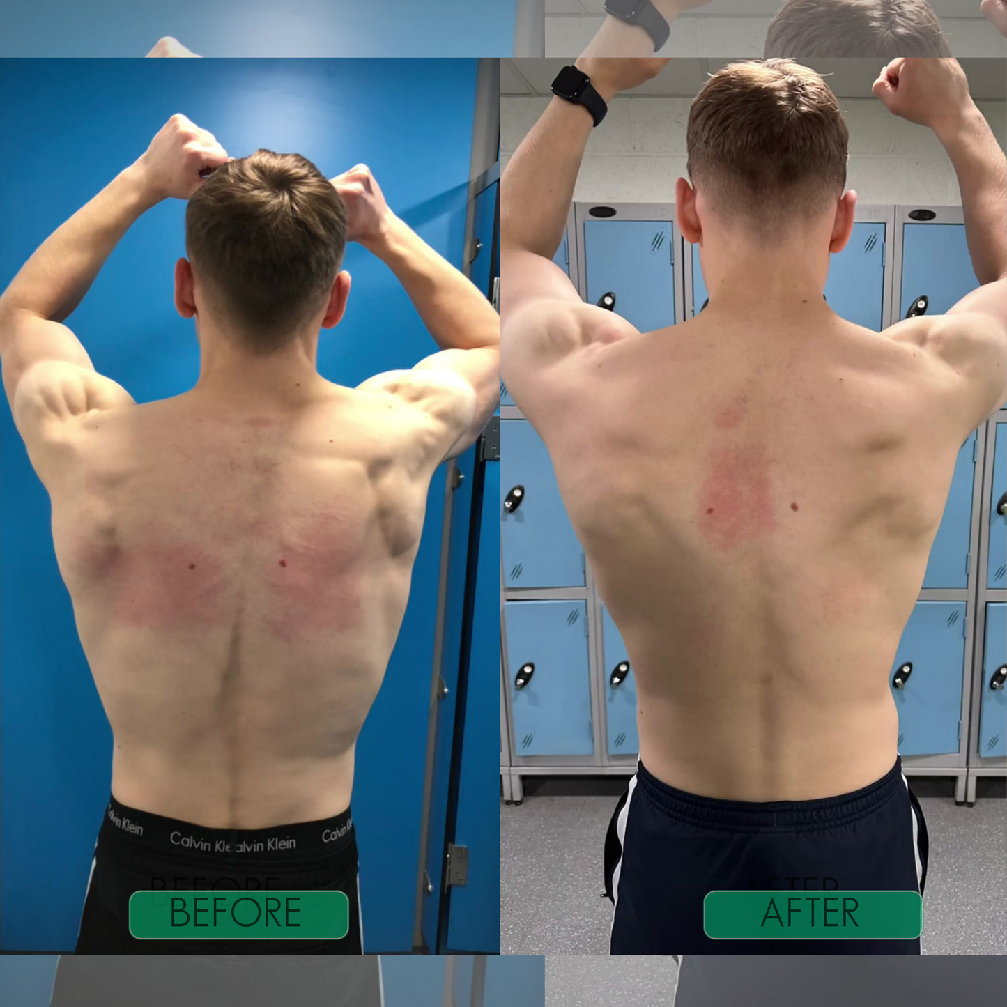 Posture Corrector